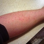 skin rashes